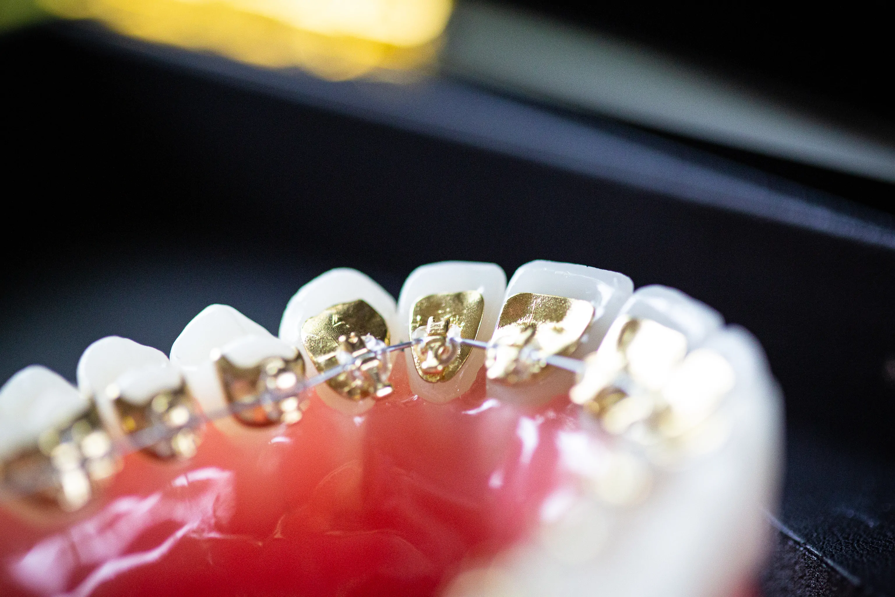 vi esteem dental 2019 orthodontic teeth 30 - Esteem Dental & Orthodontics