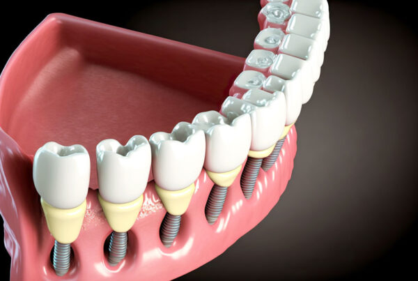 Close-up 3d model of a dental implant.