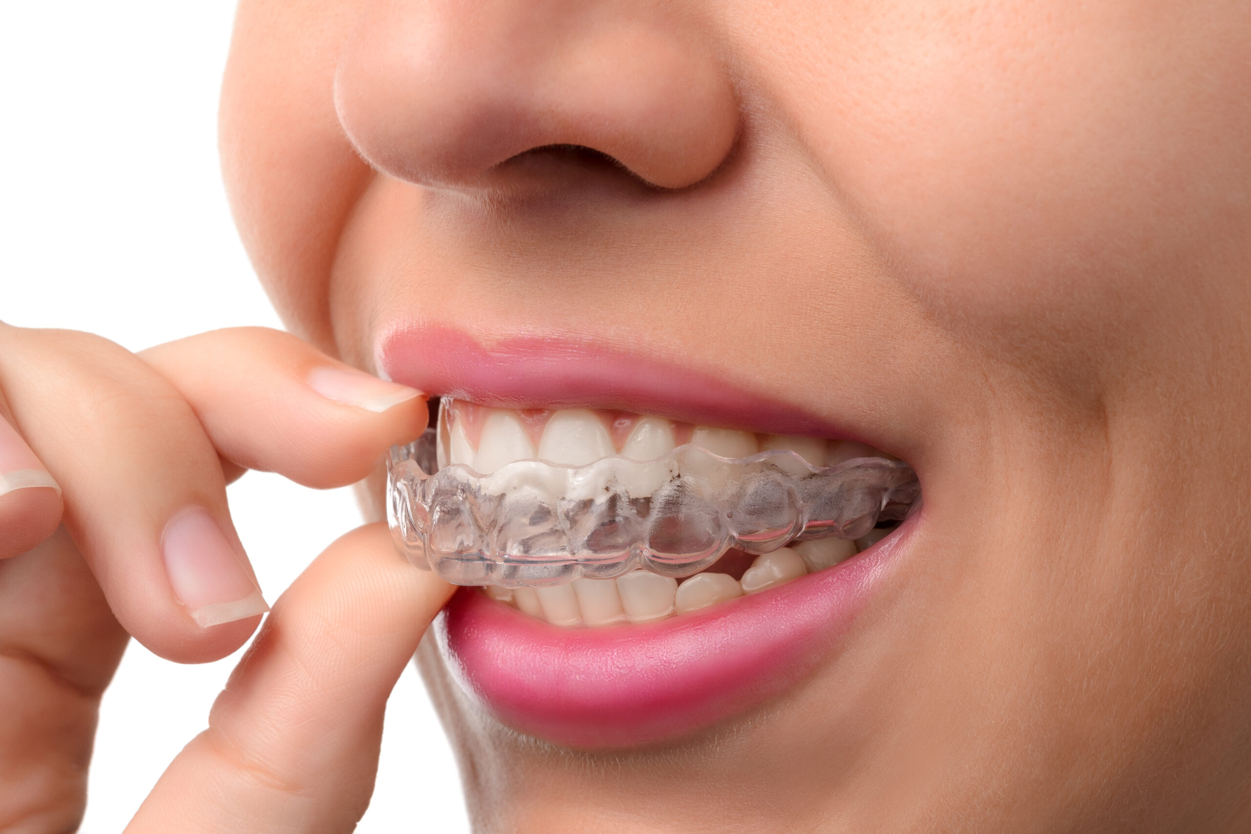 Everything You Should Know Before Starting Invisalign