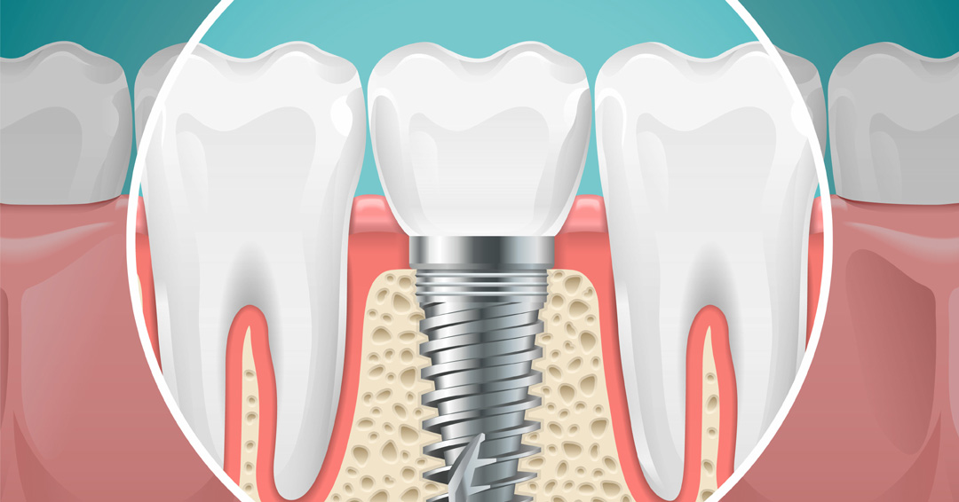What Are the Benefits of Dental Implants?
