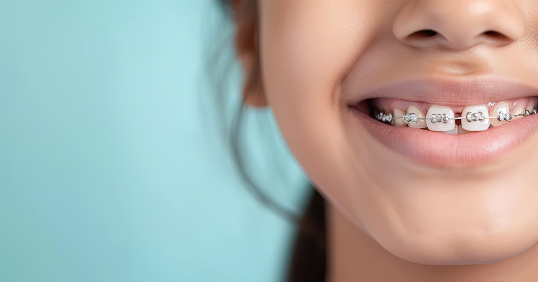 4 Signs Your Child May Need Braces