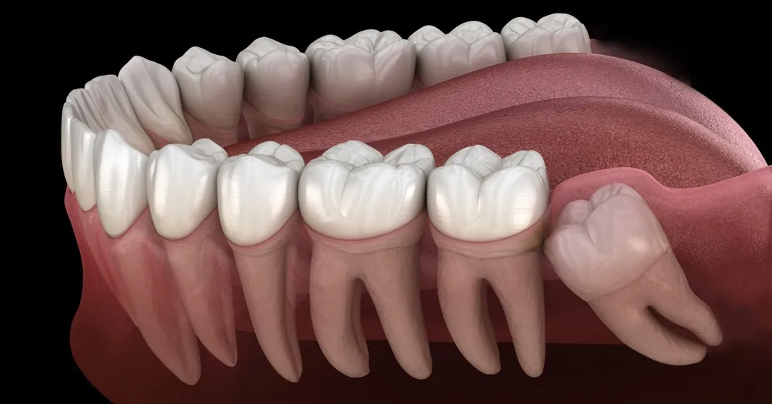 When Is Wisdom Tooth Removal Necessary?