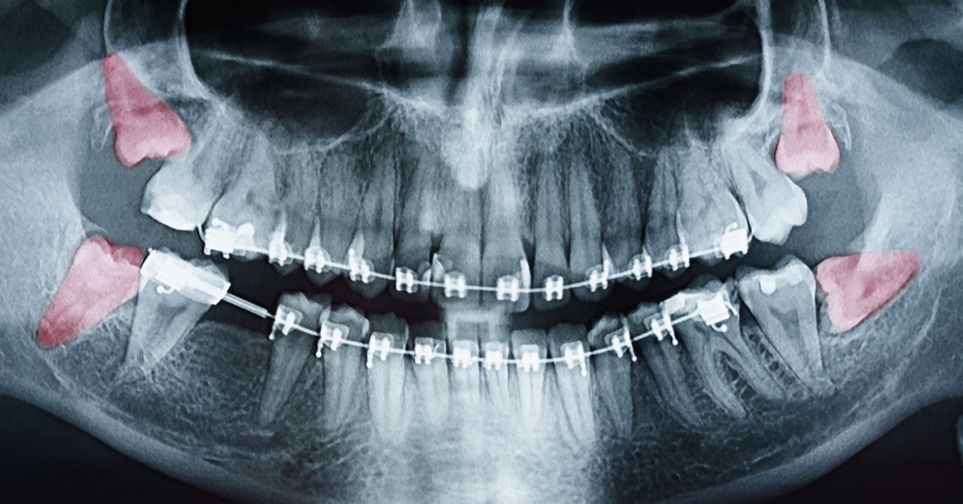 Wisdom Teeth Removal: Why Teens Shouldn’t Wait