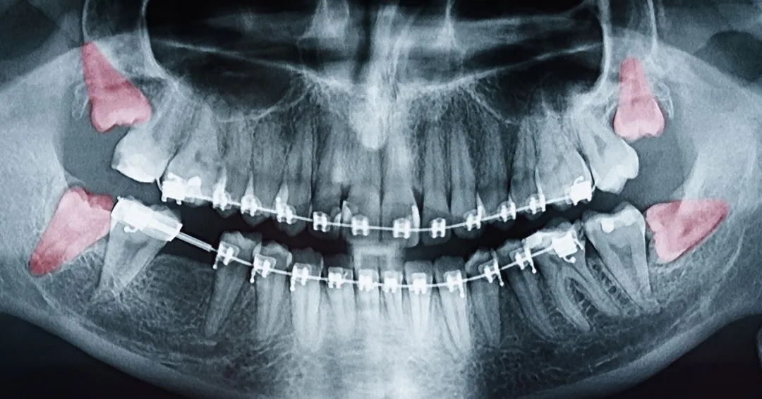 Wisdom Teeth Removal: Why Teens Shouldn’t Wait