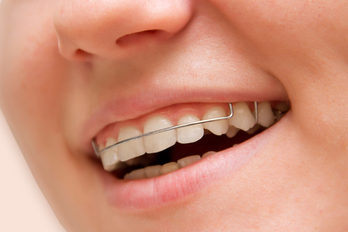 The Role of Retainers After Invisalign and How They Keep Your Smile Straight