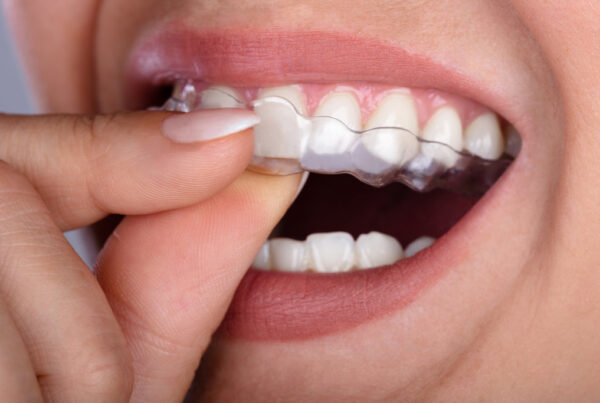 Close-up Of A Woman's Hand Putting Transparent Aligner In Teeth