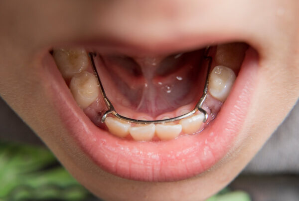 young boy showing off his lingual side dental space maintainer