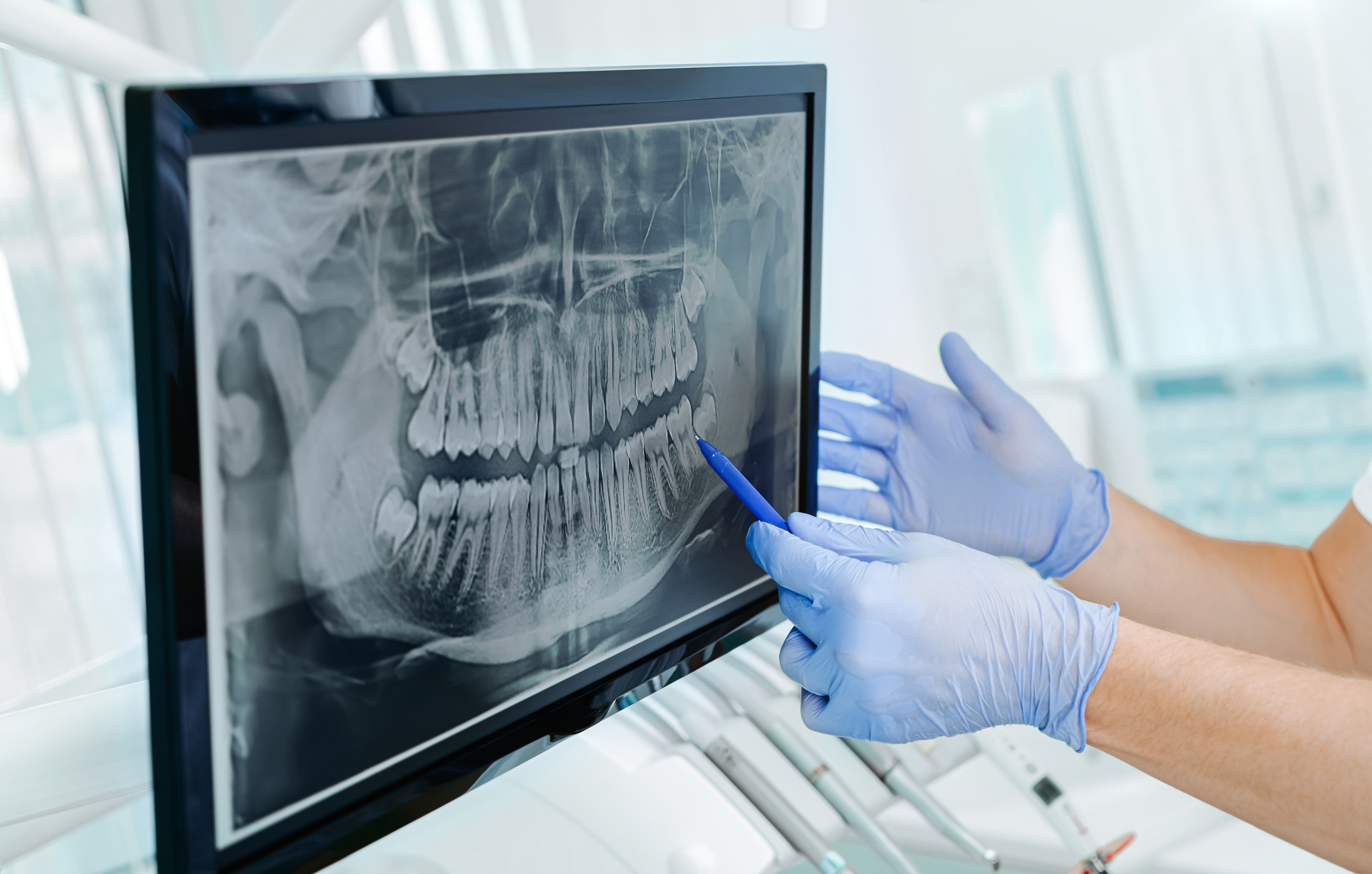 What Are Dental X-Rays and Why Are They Necessary?
