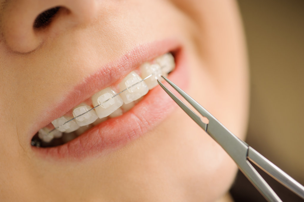 What’s the Difference Between Traditional Braces and Invisalign?