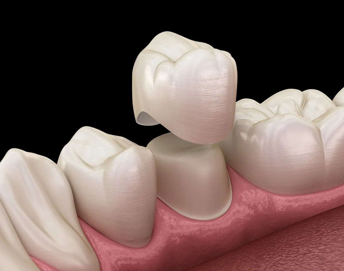 Can I Get Invisalign If I Have Dental Crowns or Bridges?