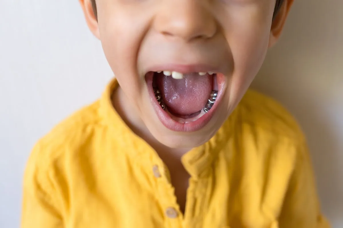 What Are Stainless Steel Crowns and When Do Children Need Them?
